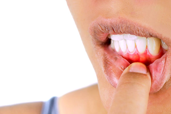 Improved Gum Health